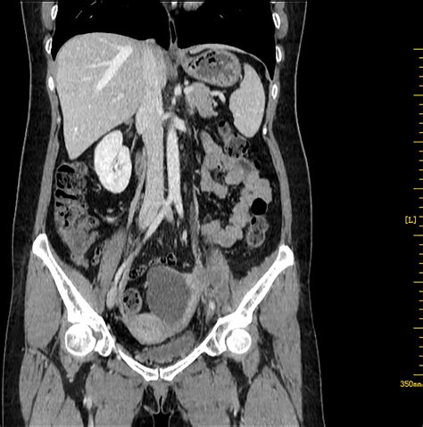 Frontiers Pure Primary Ovarian Squamous Cell Carcinoma A Case Report And Literature Review