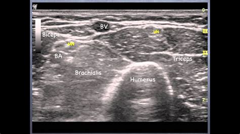 Ulnar Nerve Ultrasound