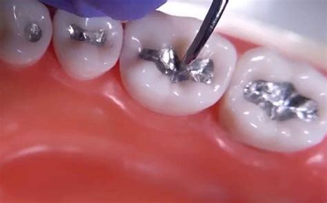 Amalgam Vs. Composite: The Skinny on Dental Fillings