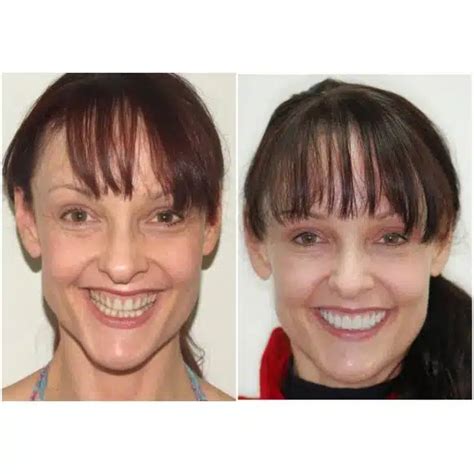 Veneers Before and After Results