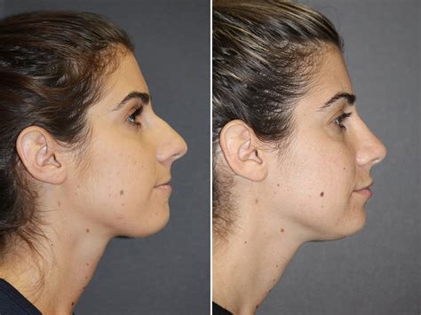 Rhinoplasty Surgery Nose Surgery Miami Fl Dr Leonard Hochstein