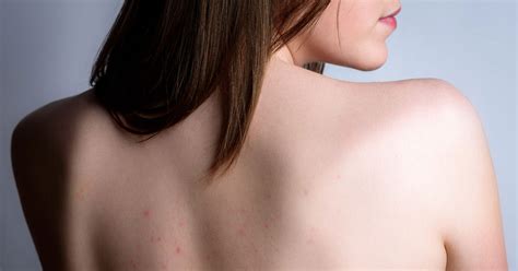 Back Acne Scars: Treatment and Prevention Strategies – Solvaderm