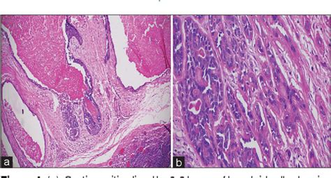 Figure 4 From Basal Cell Adenoma Of The Floor Of The Mouth Masquerading