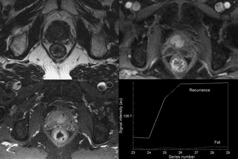 Dynamic Contrast Enhanced Mri In Prostate Cancer European Journal Of