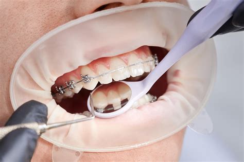 The Average Cost Of Braces Bracesetters Orthodontics