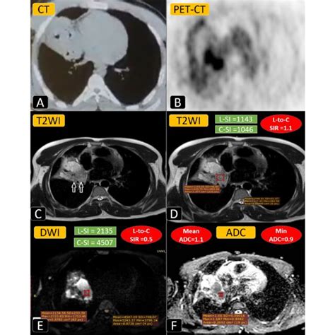 A Year Old Female Patient Complained Of Chronic Cough And Dyspnea A