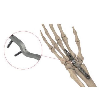 Placa De Artrodesis Para Mu Eca As W Ases Orthopedics Dorsal