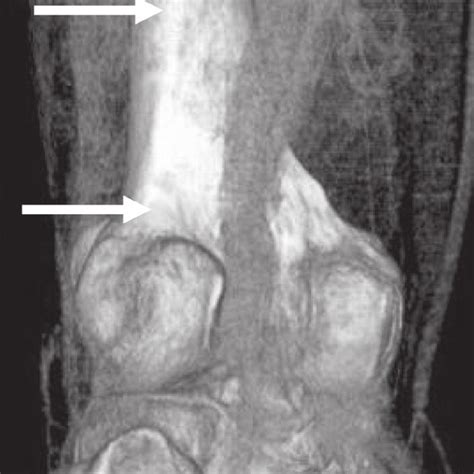 Postoperative Contrast Enhanced Computed Tomography Revealed