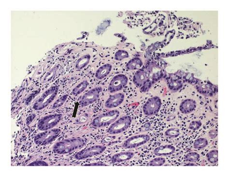 Colonic Ulcer Biopsy Demonstrating Ischemic Morphology With Download Scientific Diagram