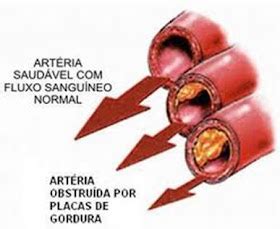 Consultoria De Enfermagem Mendes Hernandez Gordura No Sangue O Mal