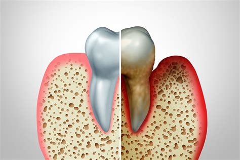 Visual Aids Showing Severe Periodontitis Shown To Motivate