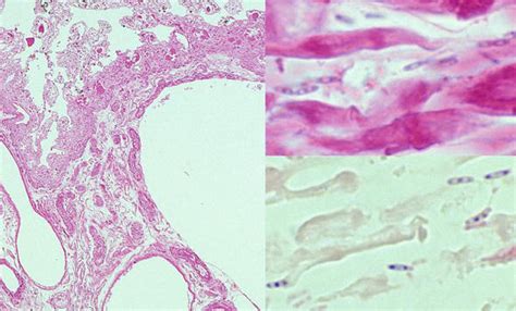 Necrotizing Ulcerative Gingivitis Histology