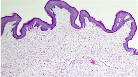 Fibroepithelial Polyp Histology