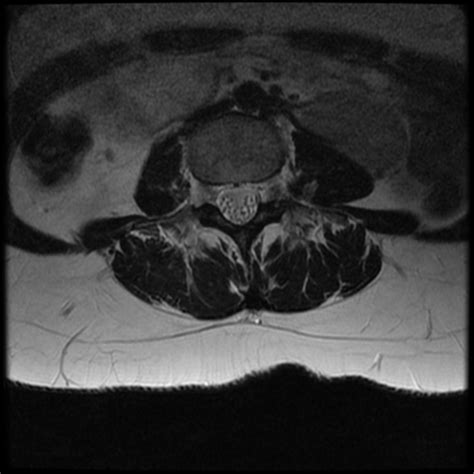 Multiple Cauda Equina Schwannomas In Neurofibromatosis Type Image