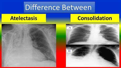 Atelectasis Vs Pneumothorax