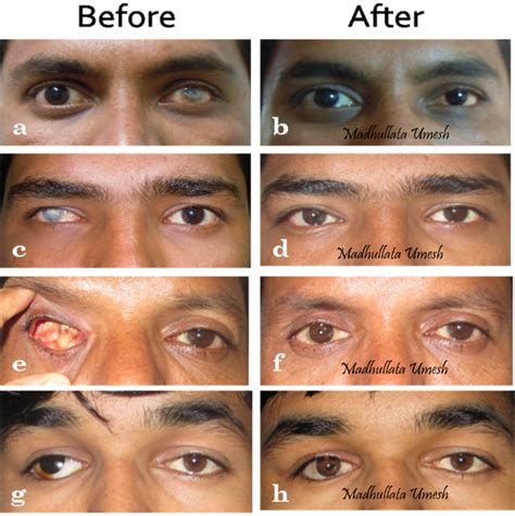 Cosmetic Rehabilitation Of The One Eyed Custom Made Ocular Prosthesis