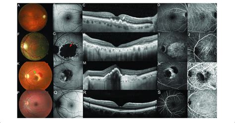 Photomicrographs Showing Different Stages Of AMD Photomicrographs