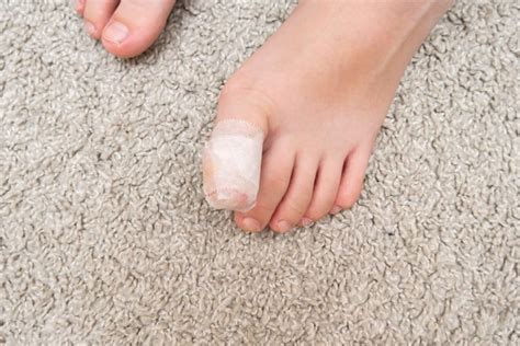 Does Ingrown Toenail Surgery Hurt Southern California Foot Ankle