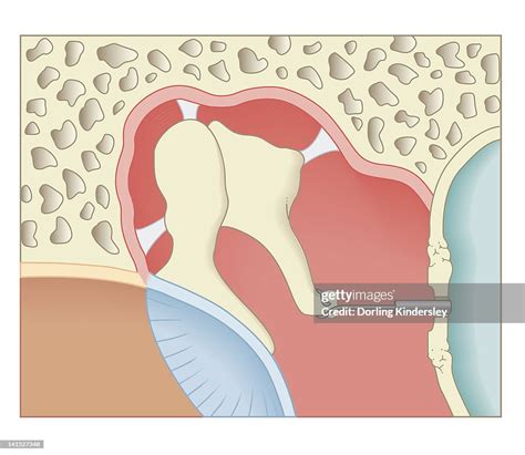 Cross Section Biomedical Illustration Of Postoperative Stapedotomy Surgery High Res Vector