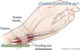 Hướng dẫn chẩn đoán và điều trị Viêm gân vùng mỏm trâm quay cổ tay