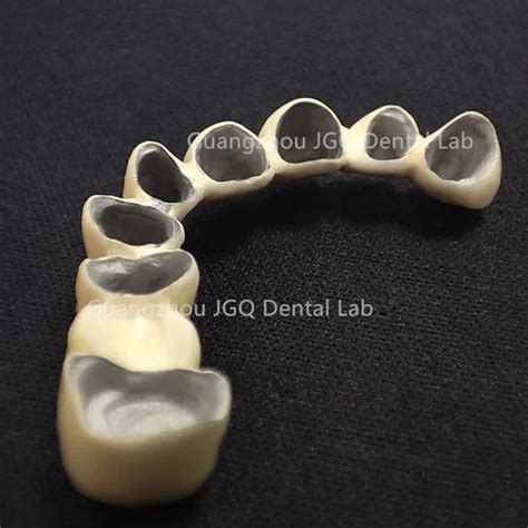 Full Arch Restorations Pfm Metal Coping Crowns With Glass Ceramics