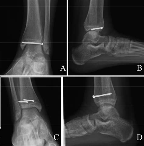 Anteroposterior A And Lateral B Radiographs Obtained 12 Months Download Scientific Diagram