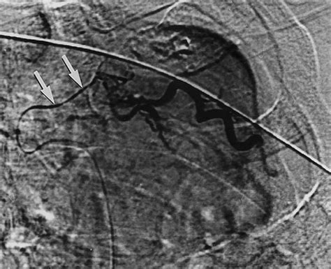 Bronchial And Nonbronchial Systemic Artery Embolization For Life