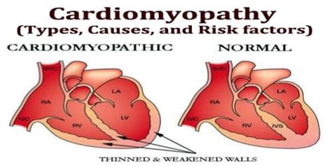 Cardiomyopathy Types Causes And Risk Factors Assignment Point