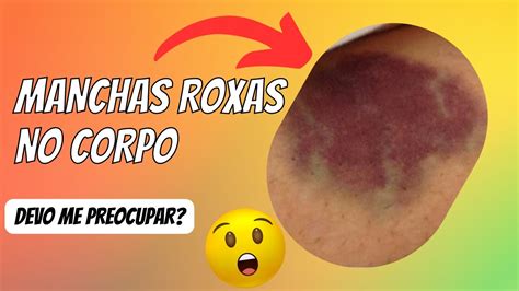Mancha Roxa O Peitoral - Manchinha Roxa No Seio - RETOEDU