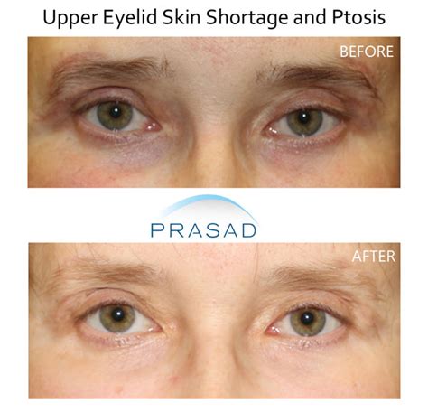 Blepharoplasty Revision Overcoming The Challenge Of Eyelids That Wont Close