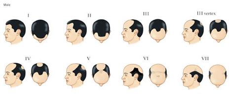 7 Stages Of Male Pattern Baldness Bald Talk