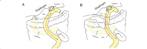 Total Gastrectomy With Roux En Y Esophagojejunostomy