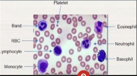 Intro Benign Hematology Flashcards Quizlet