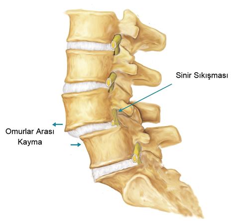 Bel Kayması Spondilolistezis Prof Dr Levent Altınel Antalya