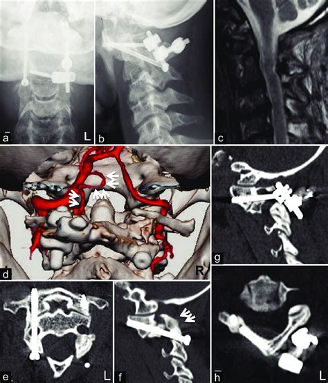 Postoperative Radiographical Examinations A And B Anteroposterior