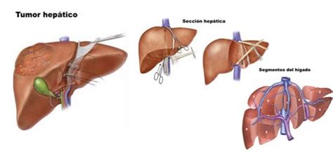 Cirugia Cancer Estomago Higado Pancreas Vesicula Colon Esofago