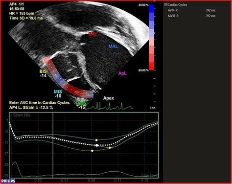 Frontiers Echocardiographic Imaging And Ventricular Mechanics In