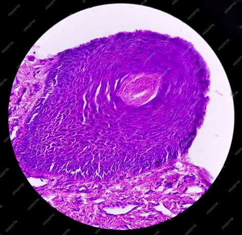 Biopsia De Piel Bajo Microscopía Sugestiva De Carcinoma De Células