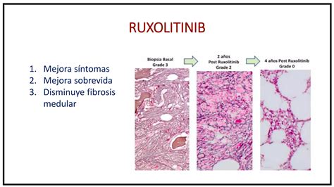 Neoplasias Mieloproliferativas Phi PPT