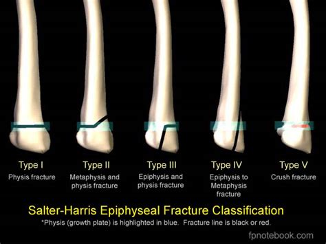 Epiphyseal Fracture