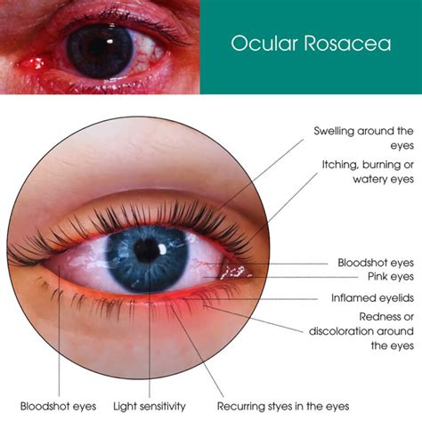 Ocular Rosacea Treatment NYC | Ocular Rosacea Specialist New York