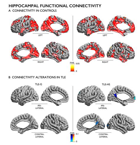 Structure-function-phenotypes-in-temporal-lobe-epilepsy