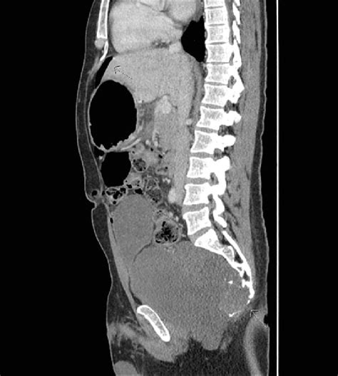 Ct Abdomen And Pelvis Sagittal View With Iv Contrast Showed Free Download Scientific Diagram