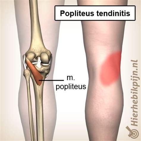 Popliteus Tendinitis