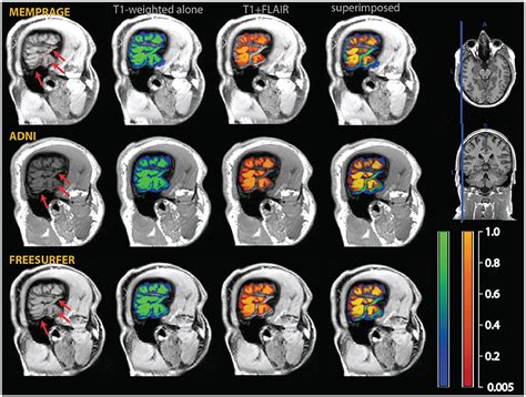 Frontiers Multimodal MEMPRAGE FLAIR And R2 Segmentation To Resolve