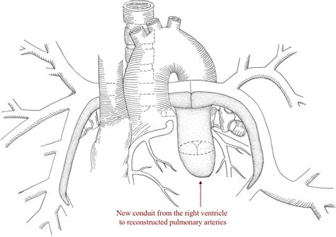 Surgical Management Of Pulmonary Atresia With Ventricular Septal Defect