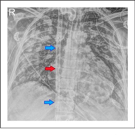 Figure From Experience With The Crescent Cannula For Adult