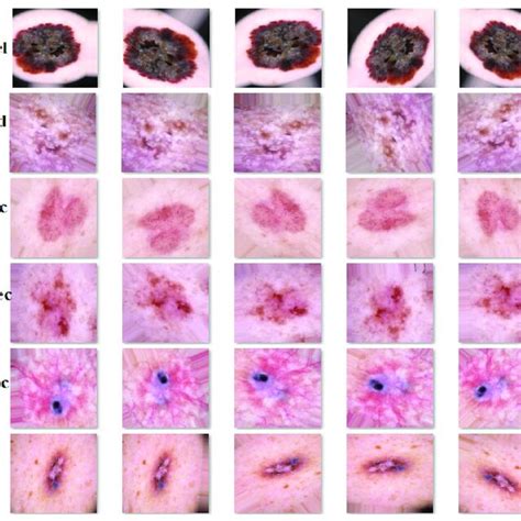 Sample Dermoscopic Images Of Skin Lesions After Data Augmentation