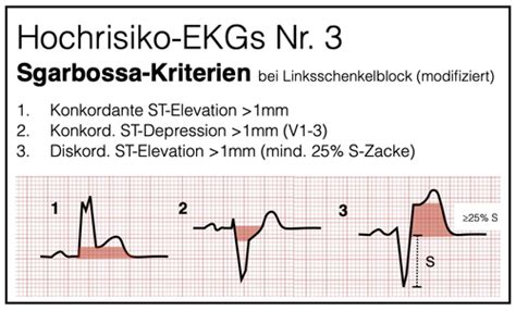 Akutes Koronar Syndrom Und Myokardinfarkt Karteikarten Quizlet