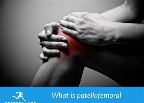 What Is Patellofemoral Syndrome Of The Knees Physiotherapy Jersey